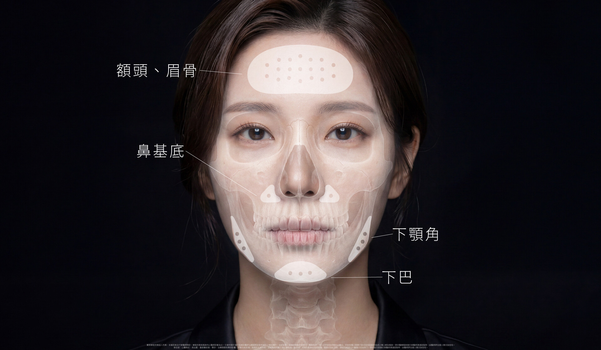 打破視覺迷思:PEEK適用於哪些輪廓重建?