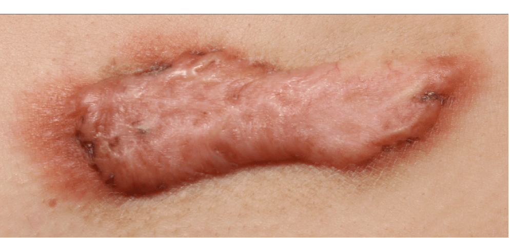 案例蟹足腫疤痕型態