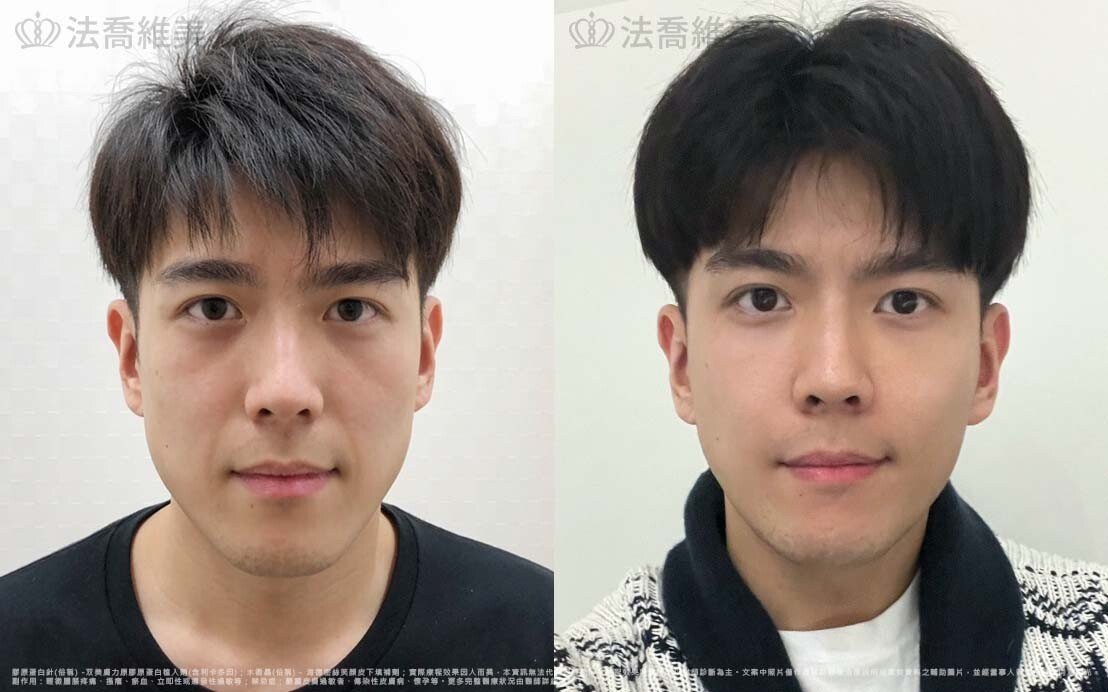 膠原蛋白針 讓你擺脫熬夜疲憊感