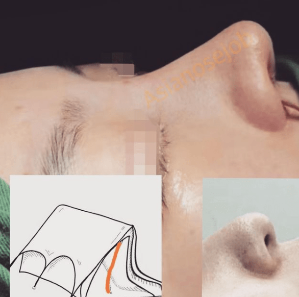 鼻翼緣退縮怎麼處理