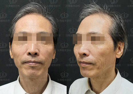 粹究美學診所 淨膚雷射 醫美不敗入門款搶救膚質最划算