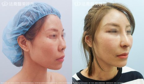 素人1 異體真皮鼻唇溝 法令 填補術 法喬維美醫美診所 台北 台中 高雄