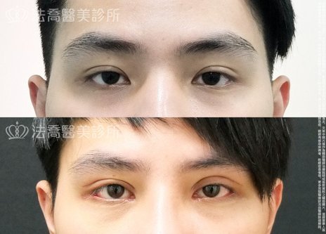 素人49 割雙眼皮 開眼頭 開眼尾 法喬維美醫美診所 台北 台中 高雄