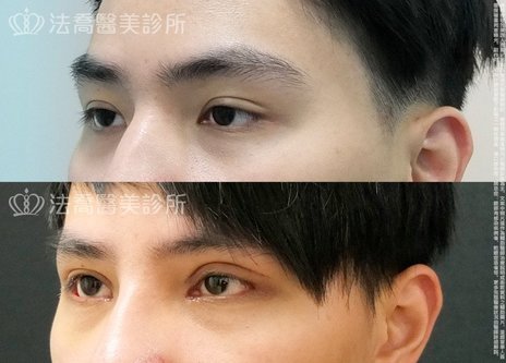 素人49 割雙眼皮 開眼頭 開眼尾 法喬維美醫美診所 台北 台中 高雄