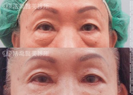 這招減少眼袋手術後外翻的機率 法喬醫美診所 台北 台中 高雄