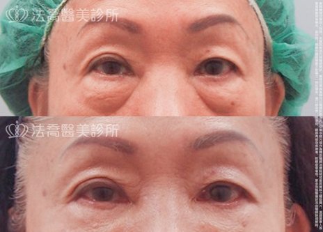 這招減少眼袋手術後外翻的機率 法喬醫美診所 台北 台中 高雄 這招減少眼袋手術後外翻的機率 法喬醫美診所 台北 台中 高雄