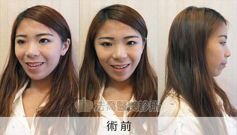 隆鼻案例 蕎蕎 卡麥拉隆鼻 鼻截骨 法喬維美醫美診所 台北 台中 高雄