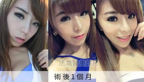 隆鼻案例 蕎蕎 卡麥拉隆鼻 鼻截骨 法喬維美醫美診所 台北 台中 高雄