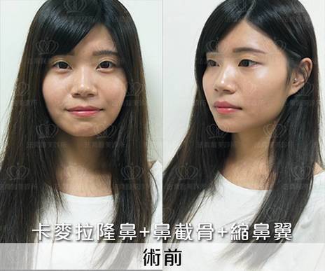 隆鼻案例 Dara 卡麥拉隆鼻 鼻截骨 縮鼻翼 法喬醫美診所 台北 台中 高雄