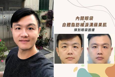 眼袋案例 韋賦 眼袋內開 自體脂肪豐蘋果肌 法喬維美醫美診所 台北 台中 高雄