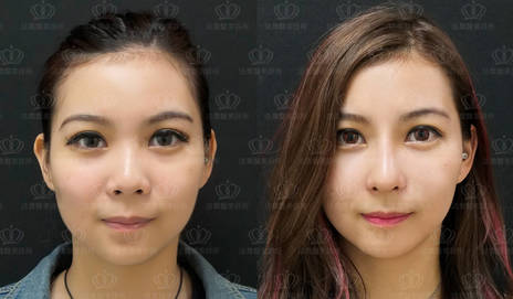 隆鼻案例 程心 自體肋骨隆鼻 縮鼻翼 法喬維美醫美診所 台北 台中 高雄