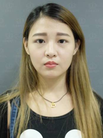 眼袋案例 夏夏 眼袋內開 縫雙眼皮合併眼瞼肌提拉術 開眼頭 眼尾下置術 自體脂肪豐全臉 法喬維美醫美診所 台北 台中 高雄 眼袋案例 夏夏 眼袋內開 縫雙眼皮合併眼瞼肌提拉術 開眼頭 眼尾下置術 自體脂肪豐全臉 法喬維美醫美診所 台北 台中 高雄