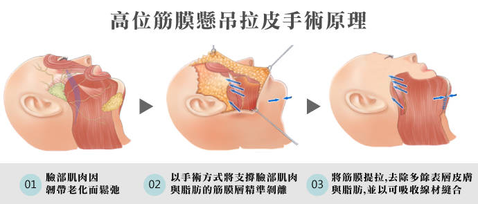 前方 術 高位 切除