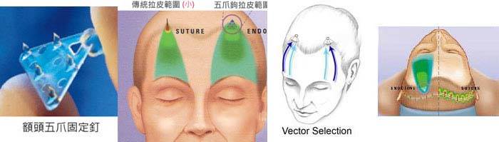 內視鏡前額五爪拉皮原理