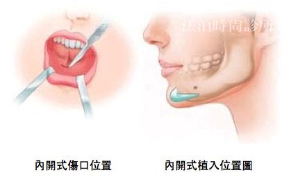 內開及外開墊下巴傷口位置