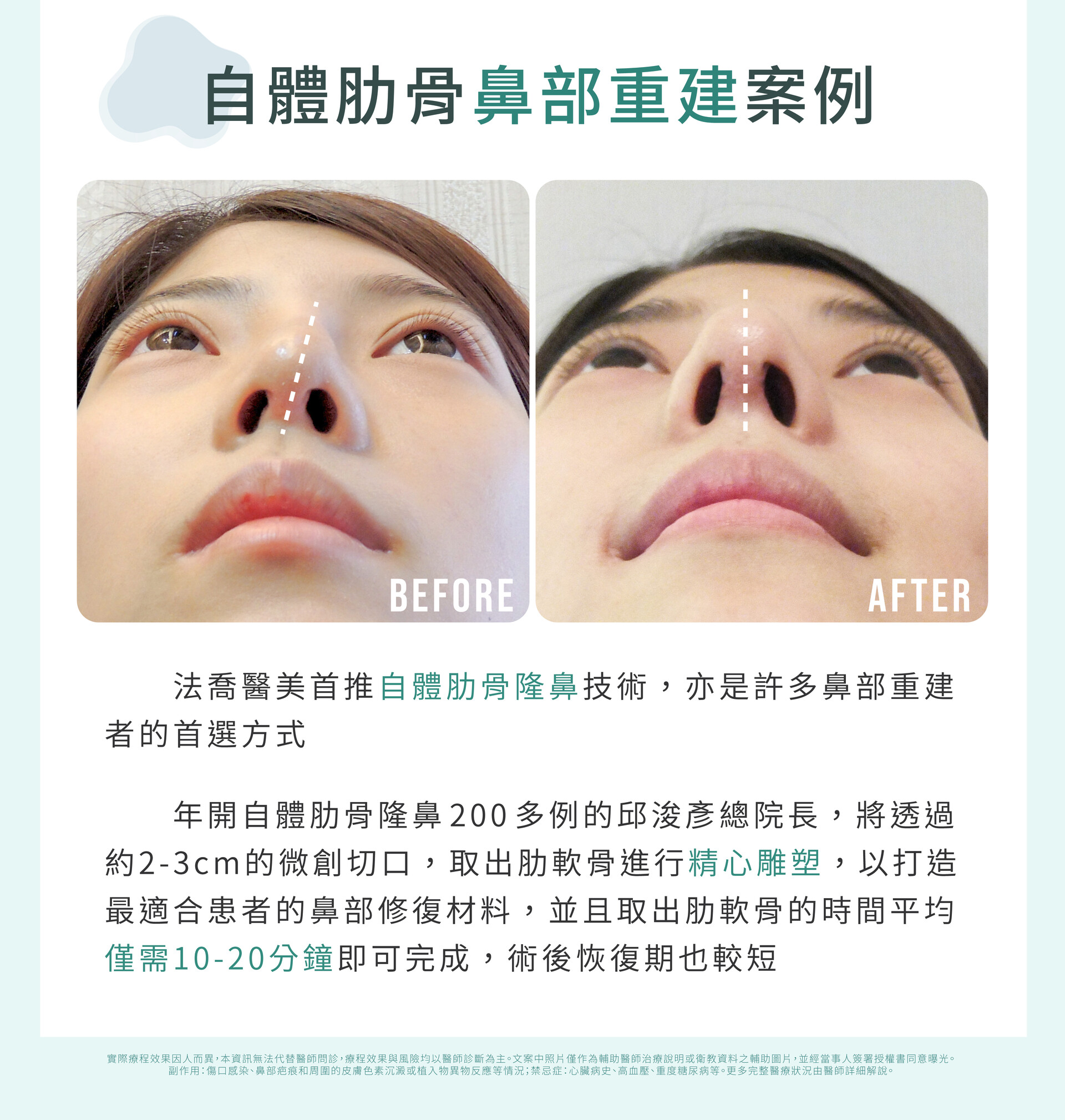 鼻部歪斜重建案例