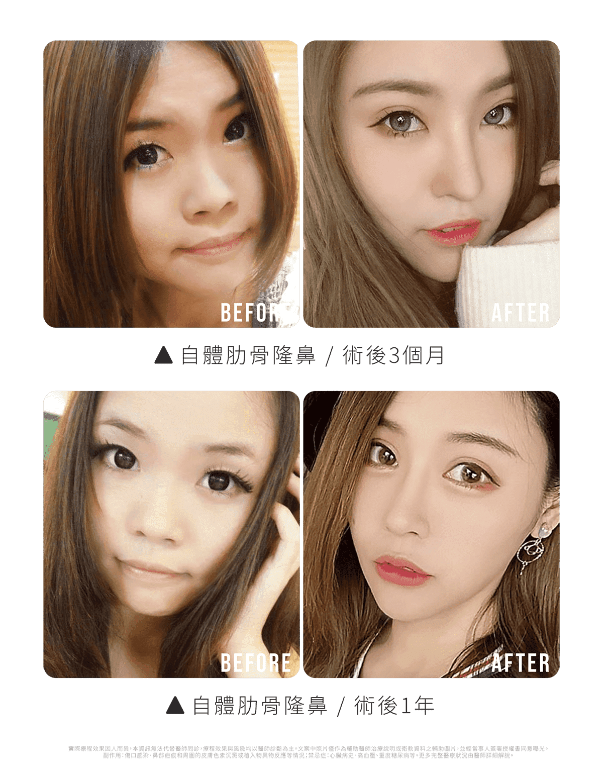 Molly隆鼻術前後對比(3個月、1年)