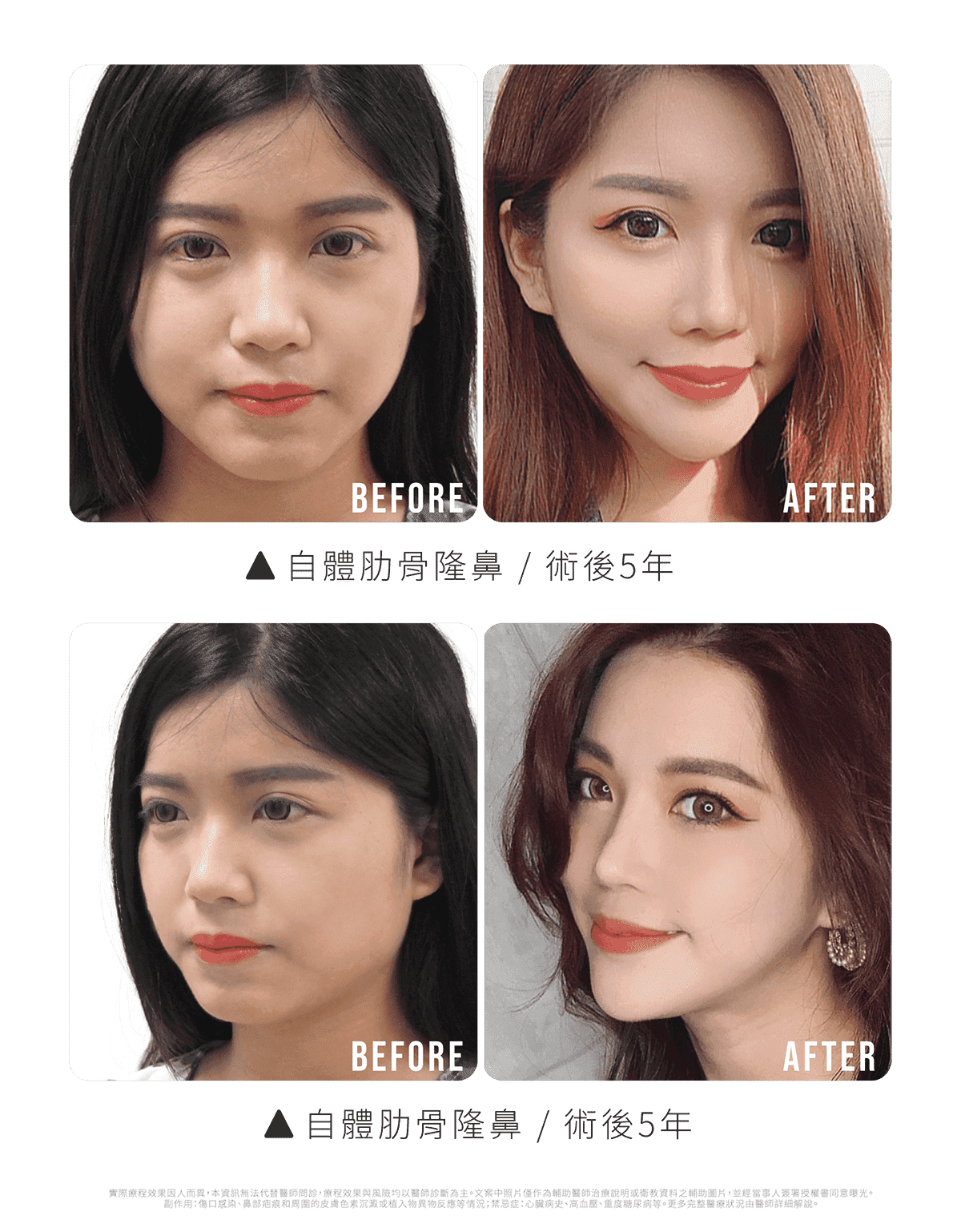 莎莎l隆鼻術前後對比(5年)