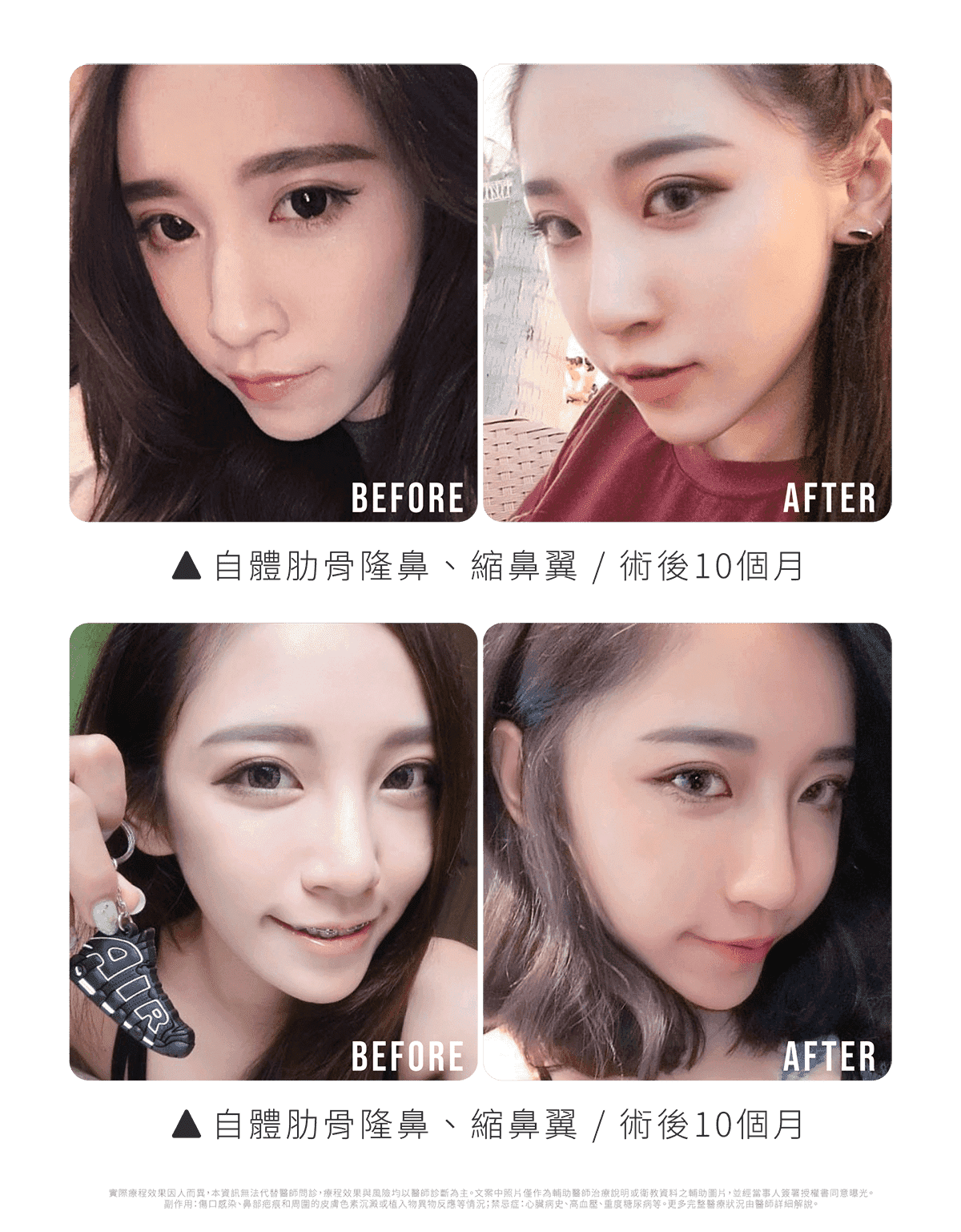 Ariel隆鼻術前後對比(10個月)