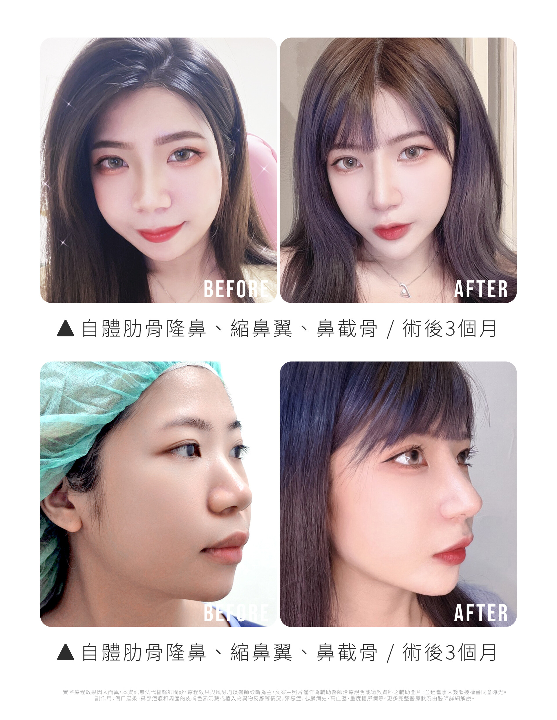 YAZ隆鼻術前後對比(1個月)