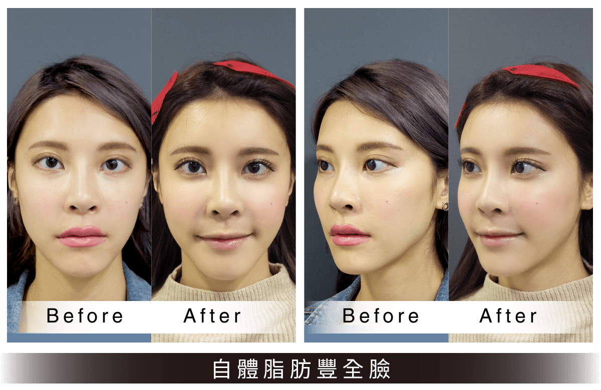 自體脂肪豐全臉案例