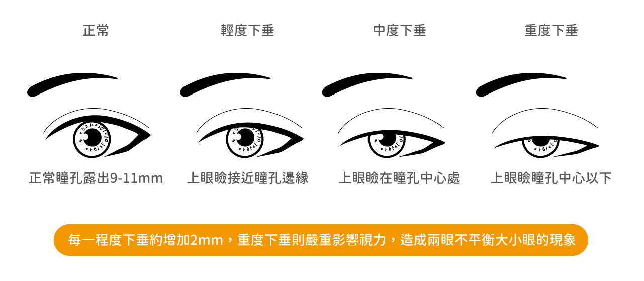 提眼瞼肌下垂分級