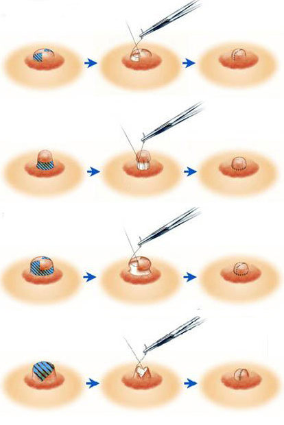 修乳頭手術方式