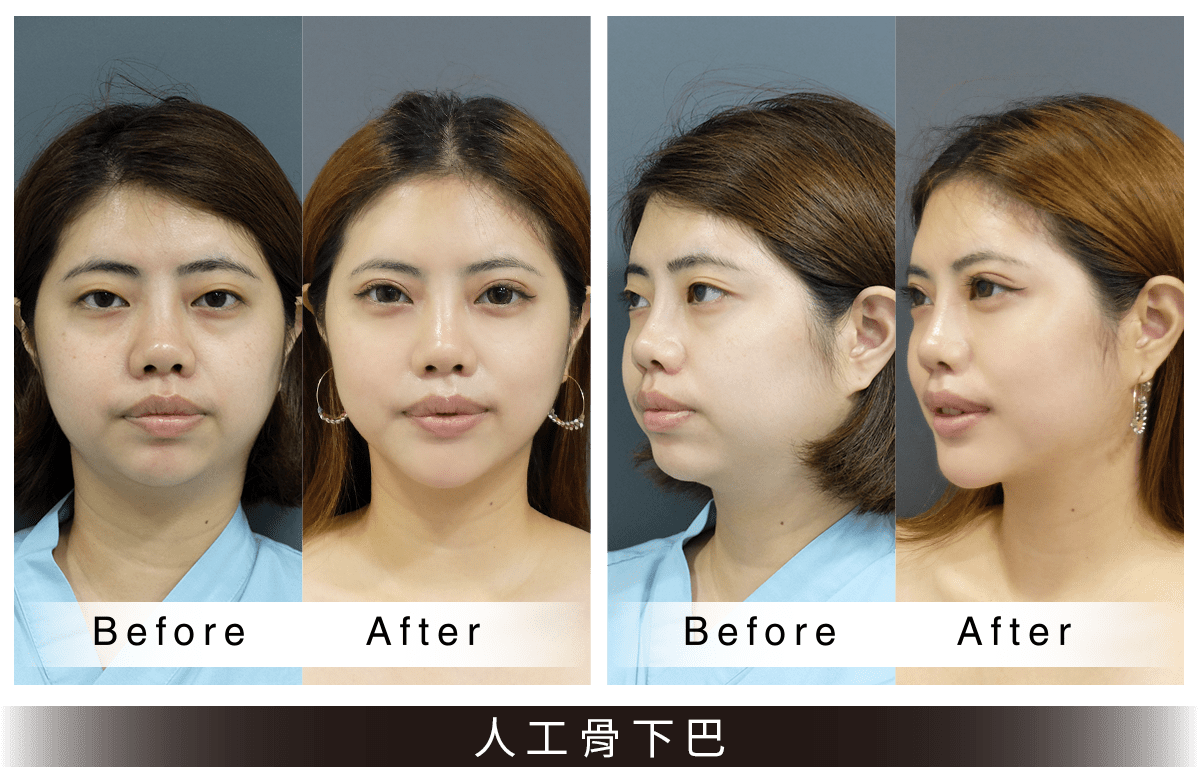 人工骨墊下巴案例