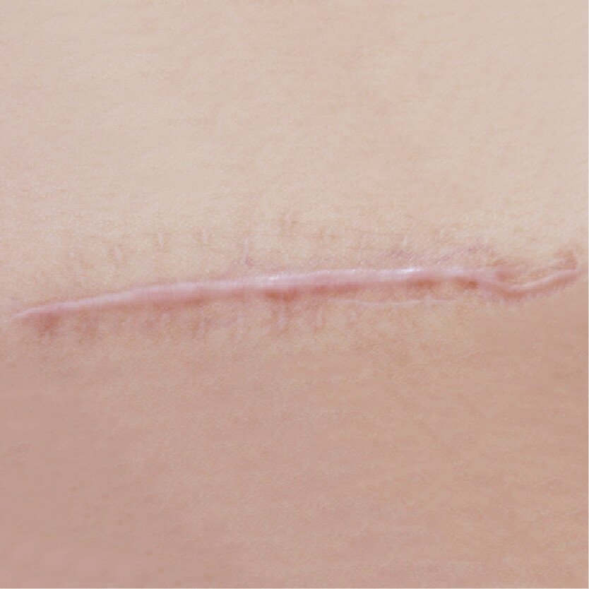 白色疤痕案例