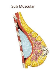 隆乳植入物置於胸大肌下