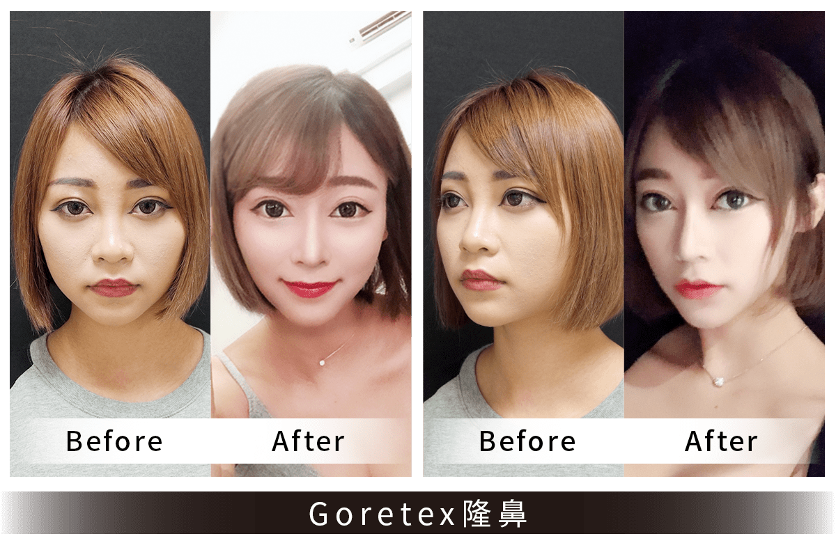 法喬維美Goretex隆鼻案例術後