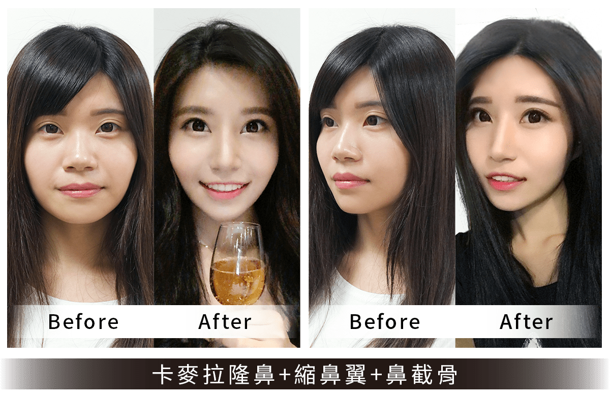 法喬維美卡麥拉隆鼻手術案例照