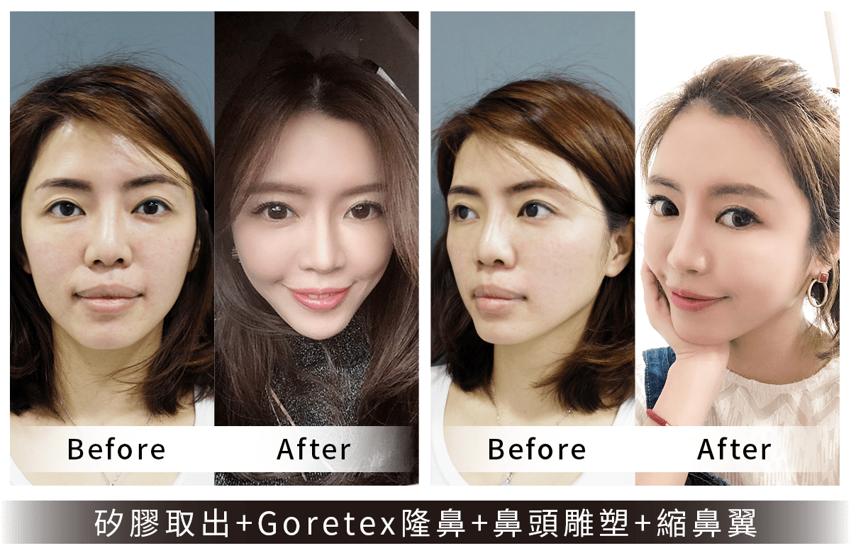 法喬維美隆鼻重修手術