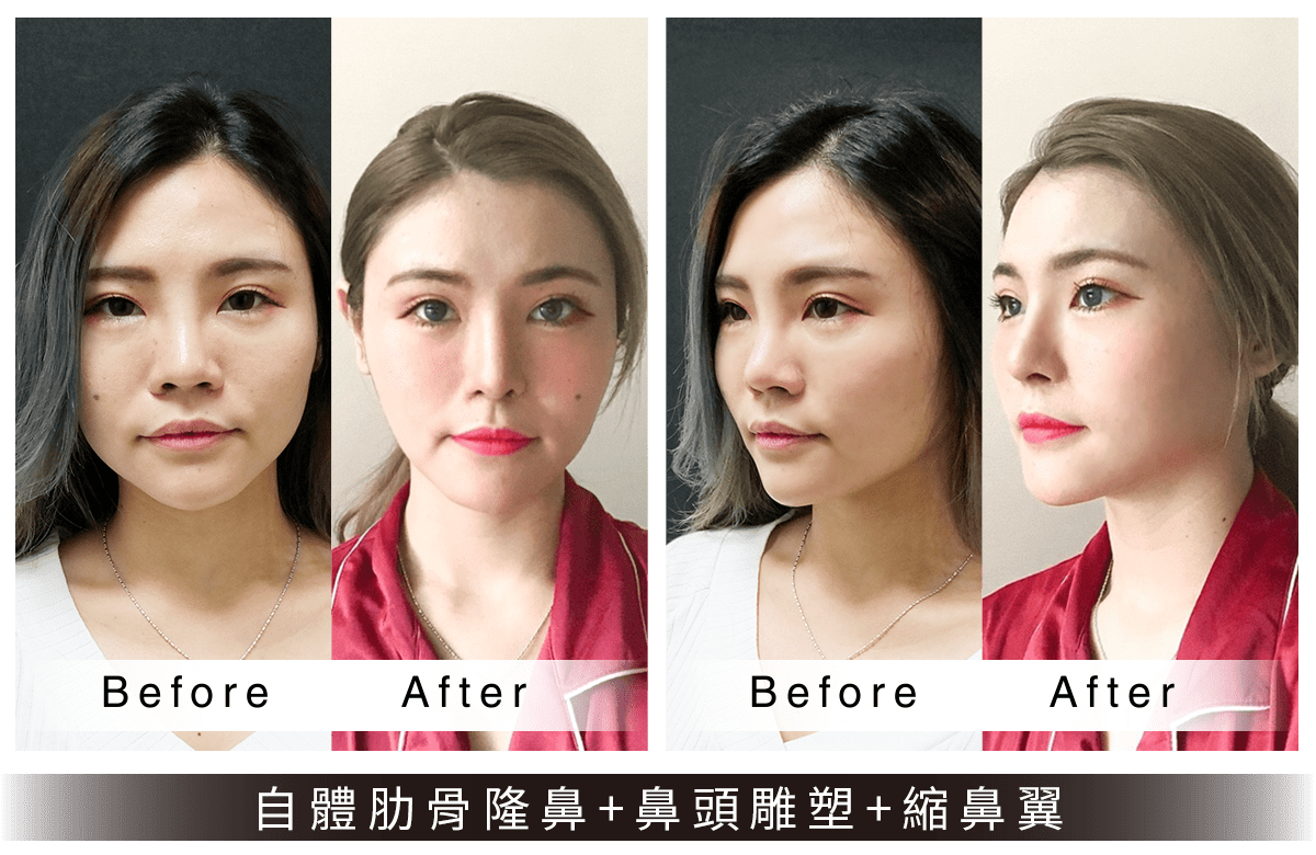 法喬維美隆鼻與縮鼻翼案例照
