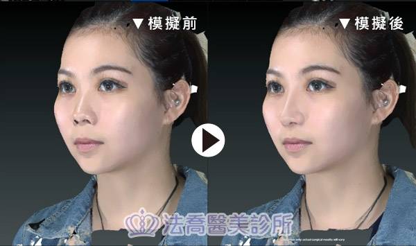 法喬醫美診所-自體肋骨隆鼻