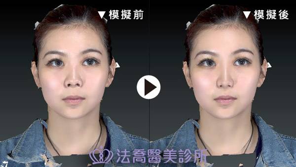 法喬醫美診所-自體肋骨隆鼻