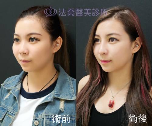 法喬醫美診所-自體肋骨隆鼻