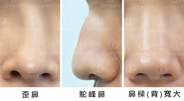 歪鼻 駝峰鼻 鼻樑寬大