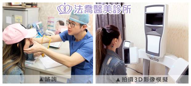 法喬醫美診所-自體肋骨隆鼻
