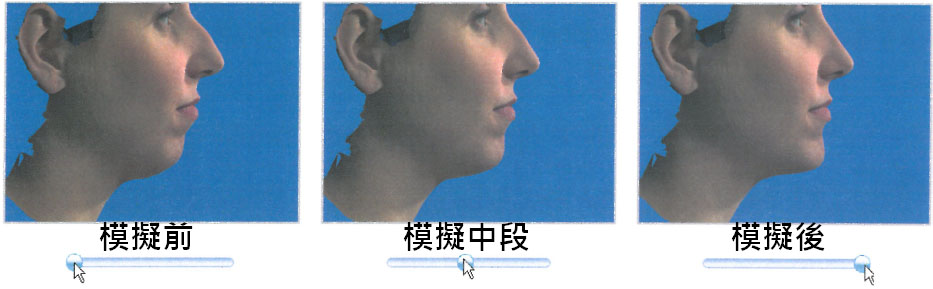 3D模擬列印下巴人工骨植入術