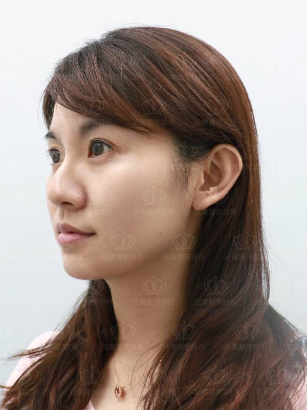 法喬醫美診所_3D模擬下巴