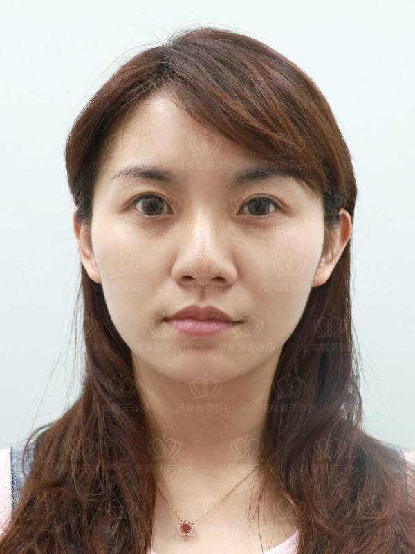 法喬醫美診所_人工骨客製化下巴