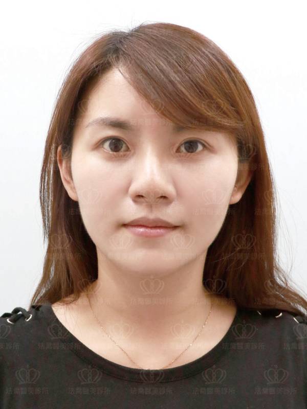 法喬醫美人工骨墊下巴術後