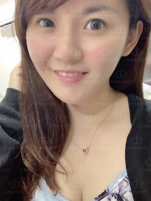 法喬醫美人工骨墊下巴術後
