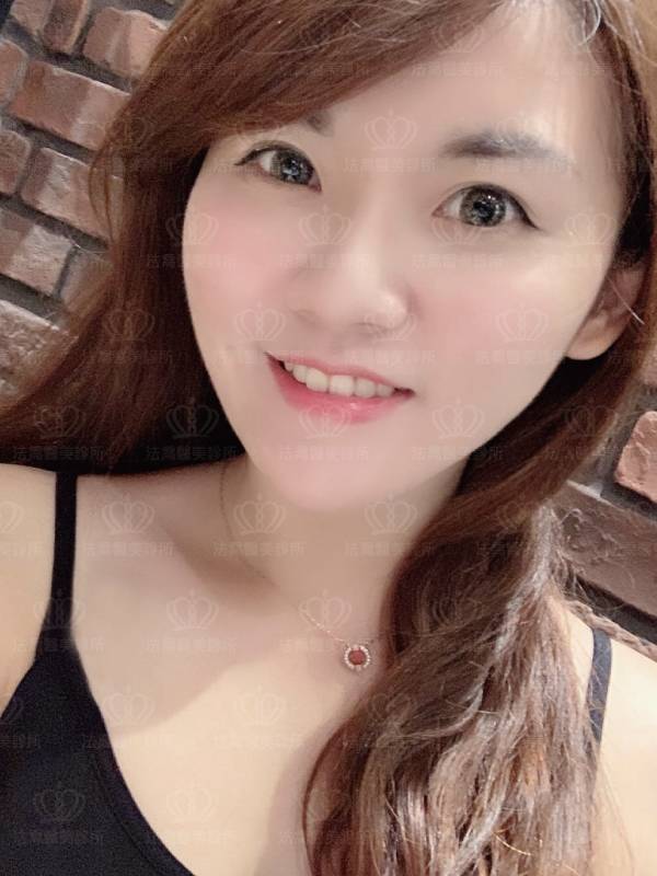 法喬醫美診所_骨水泥墊下巴