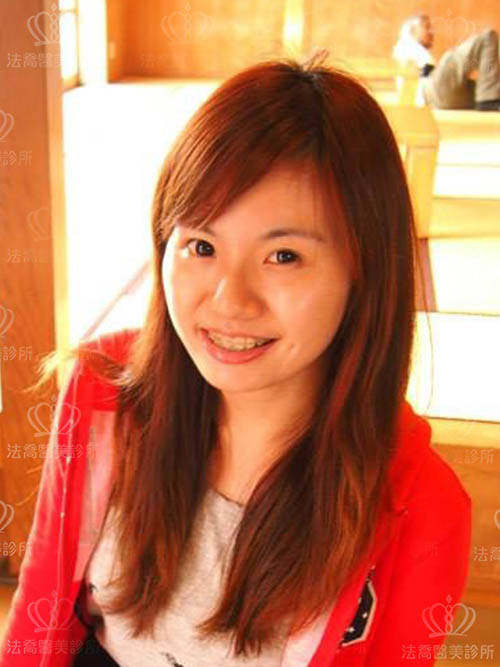 法喬醫美診所_人工骨下巴術前