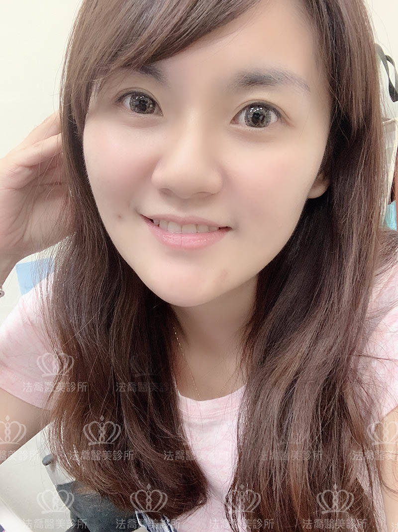 法喬醫美人工骨墊下巴術後一周