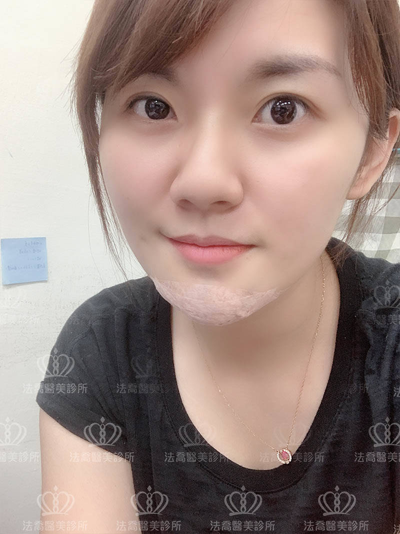 法喬醫美人工骨墊下巴術後當天
