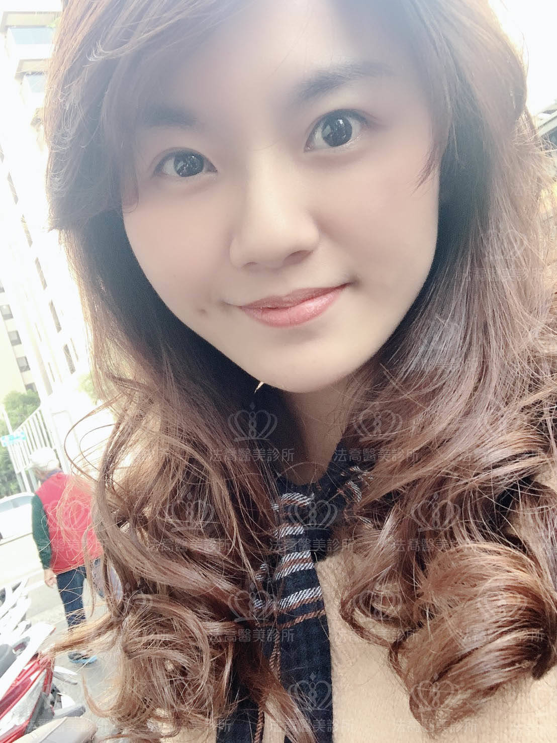 法喬醫美人工骨下巴術後2M