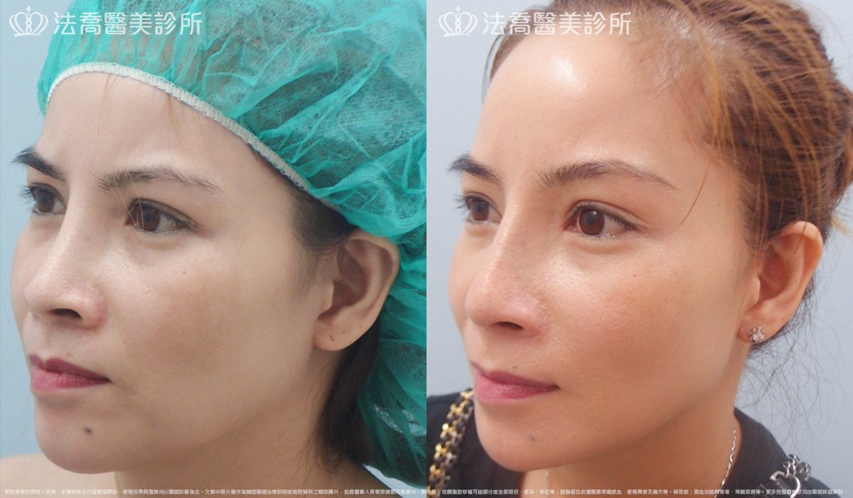 法喬醫美診所,邱浚彥,人工骨下巴